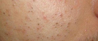 Белые комедоны на лице: как избавиться, отзывы