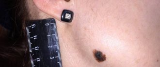 Benign mole: description, signs, photos, removal methods