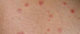 Photo of what psoriasis looks like at the initial stage
