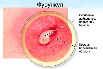 Furuncle - causes and treatment