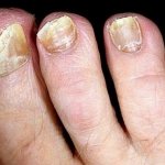 nail fungus