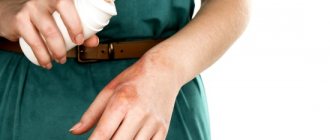 Chemical skin burn: treatment at home. Is it possible to treat a chemical skin burn at home? 