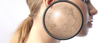 Как избавиться от сухости кожи