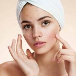 How to get rid of acne: causes, possible diseases, treatment methods, prevention