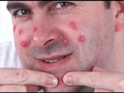 How to cure pimples on nose