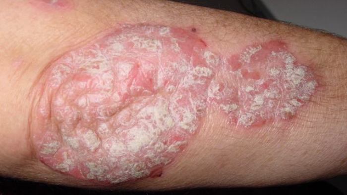 healing properties of tar soap for psoriasis