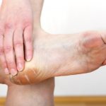Treatment of calluses with ointment