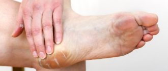 Treatment of calluses with ointment