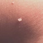 Can papillomas disappear on their own without treatment?