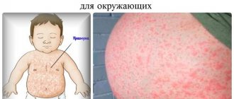 The danger of rubella