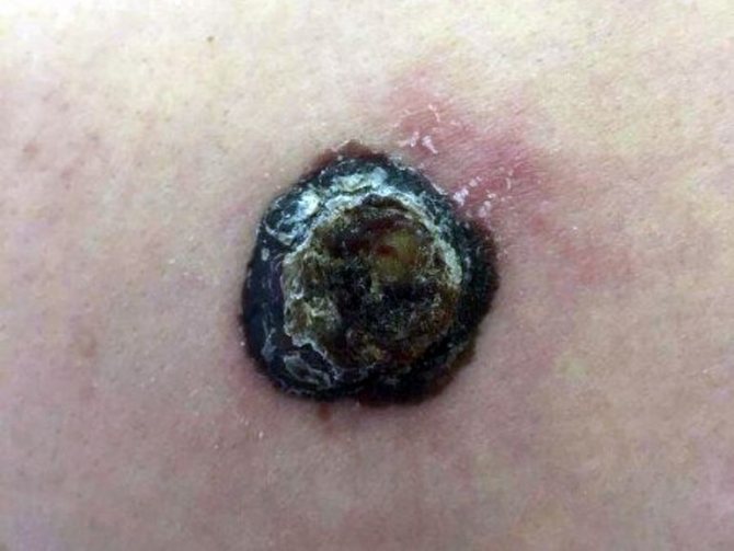 Dangerous moles on the body