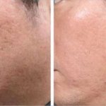 Treatment result