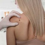 Родинки после загара: почему появляются и как их избежать? - ProdMake.ru