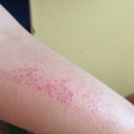 Сыпь на руках в виде маленьких прыщиков фото