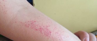 Сыпь на руках в виде маленьких прыщиков фото