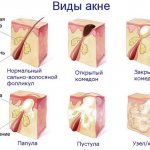 Виды акне